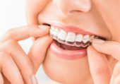 aligners